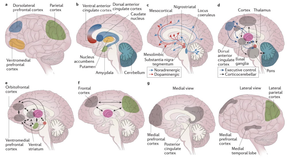 Diagrama cerebral con regiones destacadas implicadas en el TDAH, incluyendo corteza prefrontal, ganglios basales, cerebelo y sistemas dopaminérgicos/noradrenérgicos.